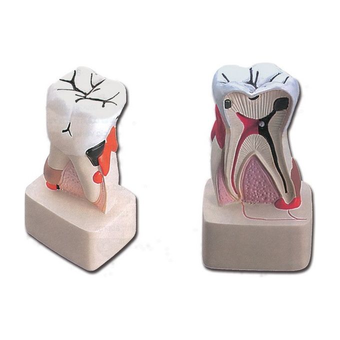Modello Patologia Dentale 1 pz.